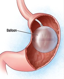 Intra Gastric Balloon