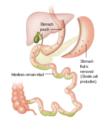 Laparoscopic Sleeve Gastrectomy